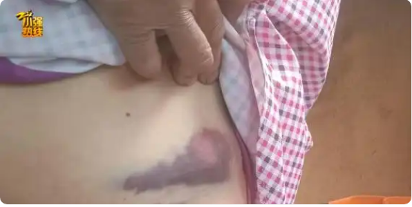 浙江女子上班路上被大狼狗扑咬，血肉模糊，伤口深达肌腱；狗主人：赔3万不可能！警方已介入